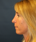 Feel Beautiful - Rhinoplasty 226 - After Photo